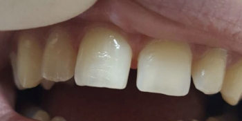 Реставрация 6-ти зубов была проведена в 2 посещения - фото №1