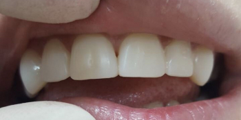 Реставрация 6-ти зубов была проведена в 2 посещения - фото №2