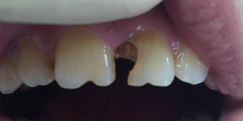 Косметическая (художественная) реставрация 2-х центральных зубов в одно посещение - фото №1