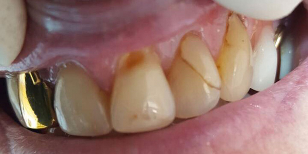 Реставрация центральных зубов без протезирования - фото №1