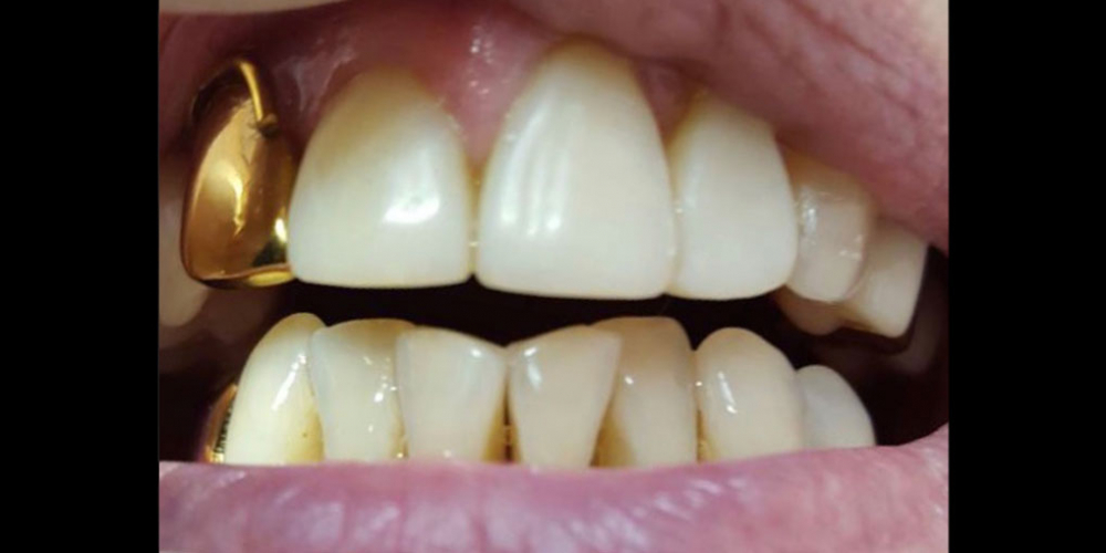 Реставрация центральных зубов без протезирования - фото №2