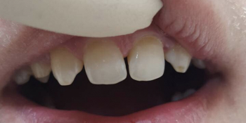 Реставрация 6-ти передних зубов без протезирования - фото №1