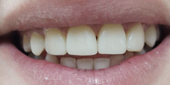 Реставрация 6-ти передних зубов без протезирования - фото №2