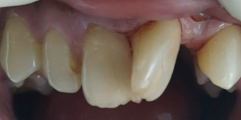 Результат эстетической реставрации 4-х зубов - фото №1