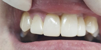 Результат эстетической реставрации 4-х зубов - фото №2