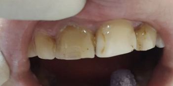 Результат эстетической реставрации 4-х зубов, материал ENAMEL PLUS - фото №1
