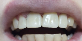 Результат эстетической реставрации 4-х зубов, материал ENAMEL PLUS - фото №2