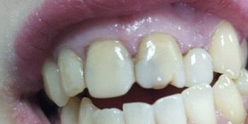 Реставрация 4-х зубов была проведена в 2 посещения всего в течение 3-х часов - фото №1