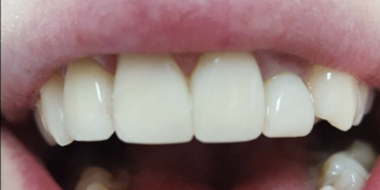 Реставрация 4-х зубов была проведена в 2 посещения всего в течение 3-х часов - фото №2