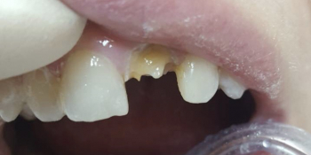 Исправление центрального зуба без протезирования за 1 час - фото №1