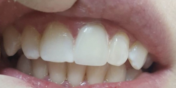 Исправление центрального зуба без протезирования за 1 час - фото №2
