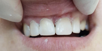 Эстетическая реставрация передних зубов, быстро и красиво - фото №2