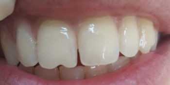 Реставрационный материал Enamel Plus, реставрация передних зубов - фото №1