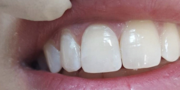 Реставрационный материал Enamel Plus, реставрация передних зубов - фото №2