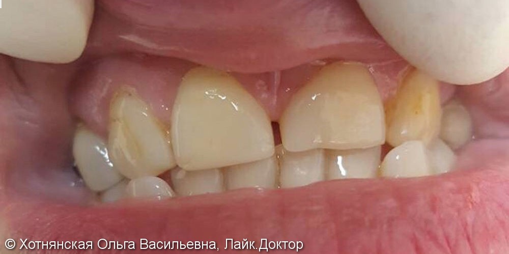 Эстетическая реставрация 4-х передних зубов - фото №1