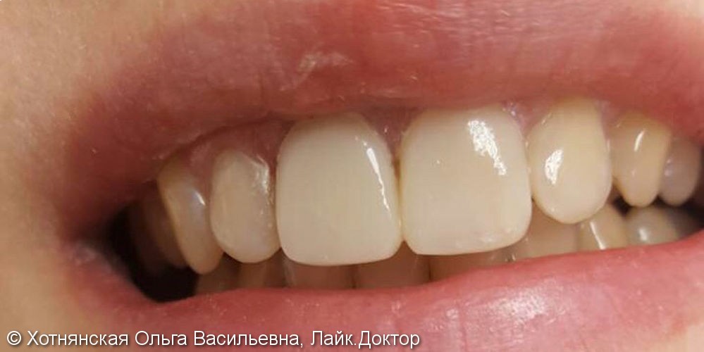 Эстетическая реставрация фронтальных зубов - быстро и не дорого - фото №2