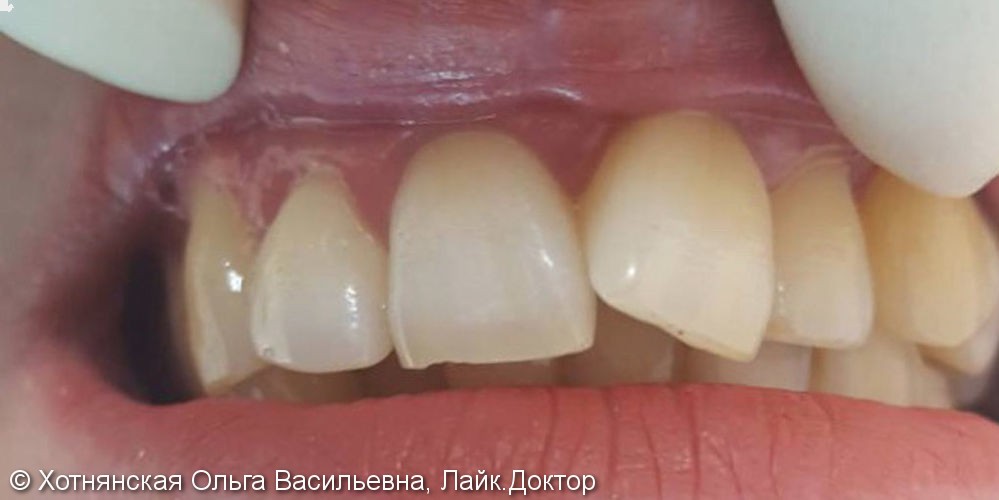 Эстетическая реставрация переднего зуба 2,1 - фото №1