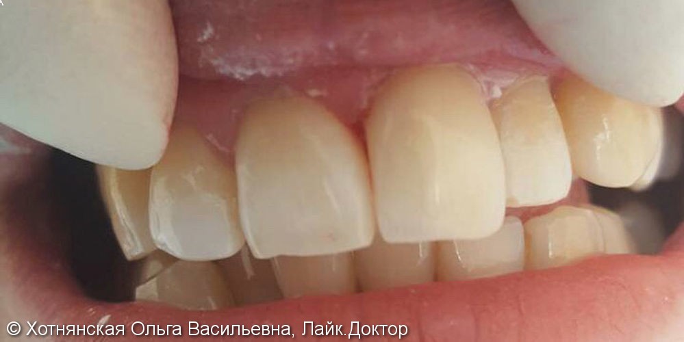 Эстетическая реставрация переднего зуба 2,1 - фото №2