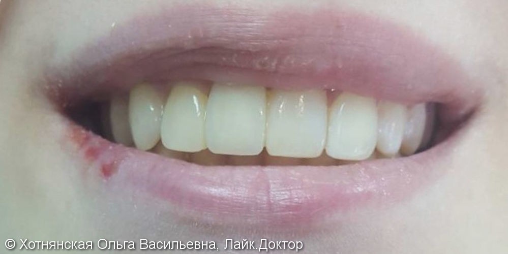Эстетическая реставрация 4-х передних зубов за 2 посещения - фото №2