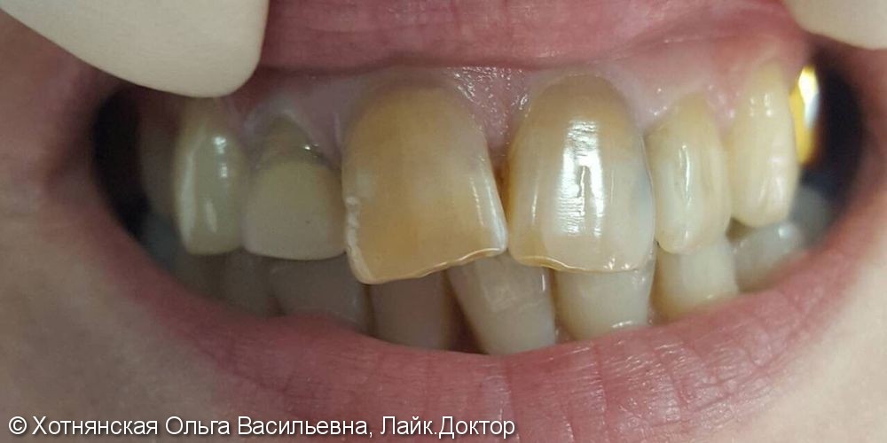 Эстетическая реставрация фронтальных зубов - это красиво, быстро, и не дорого - фото №1