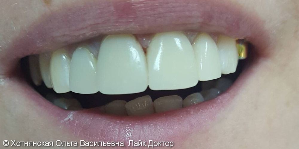 Эстетическая реставрация фронтальных зубов - это красиво, быстро, и не дорого - фото №2