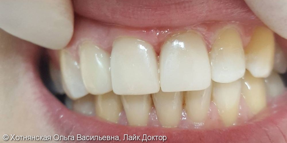 Эстетическая реставрация 3-х центральных зубов - фото №2