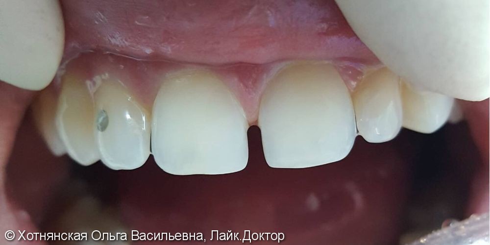 Устранение диастемы между передними зубами с помощью композита - фото №1