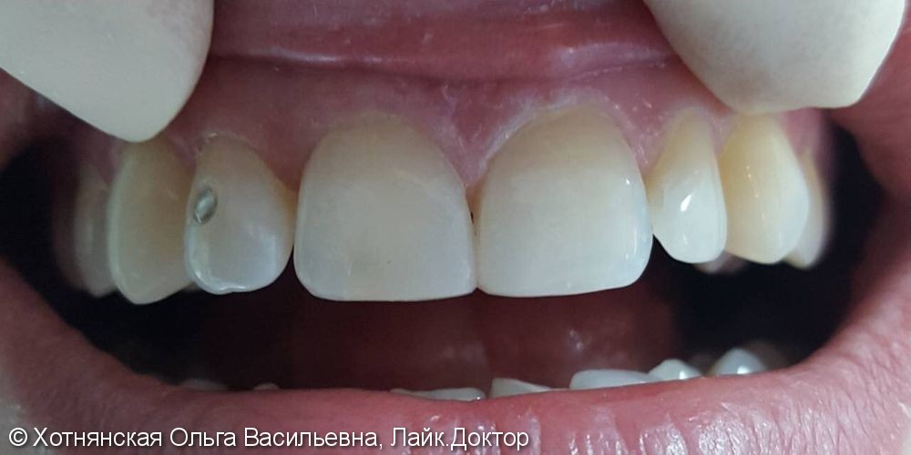 Устранение диастемы между передними зубами с помощью композита - фото №2