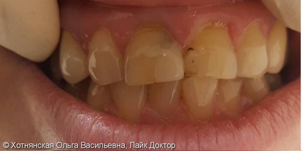 Эстетическая реставрация 2-х центральных зубов, до и после - фото №1