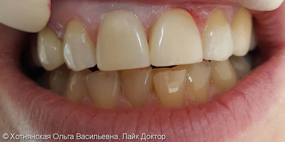 Эстетическая реставрация 2-х центральных зубов, до и после - фото №2