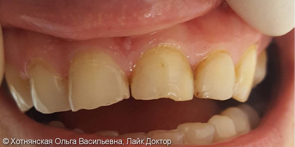 Реставрация 2-х фронтальных зубов, до и после - фото №1