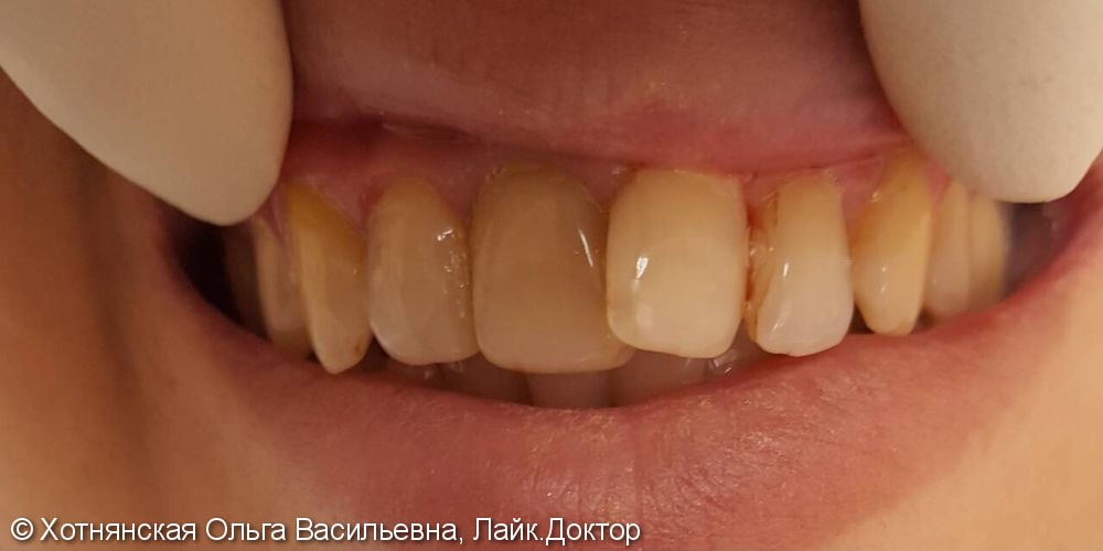 Эстетическая реставрация 3-х центральных зубов - фото №1