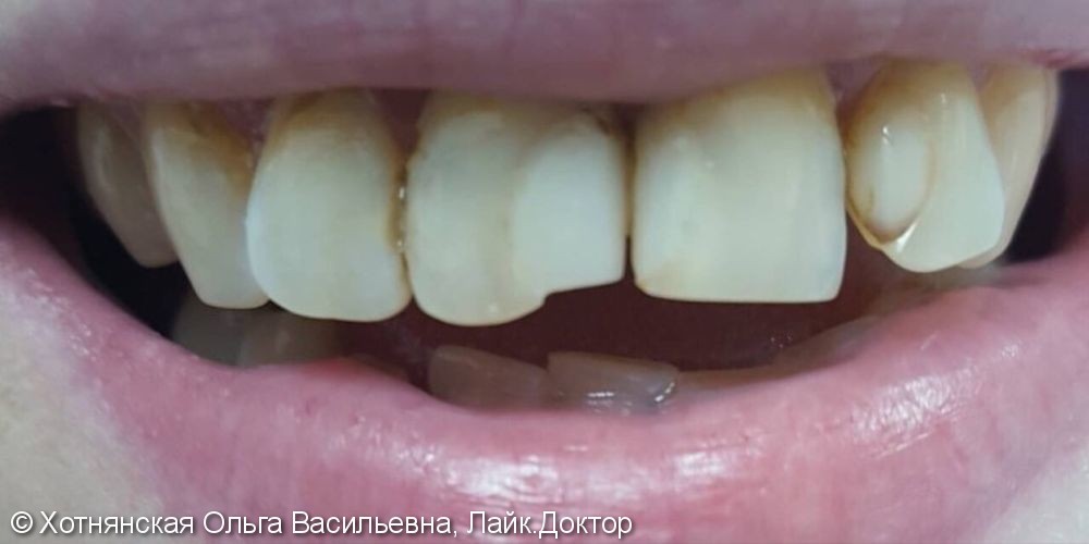 Эстетическая реставрация 3-х центральных зубов - фото №1
