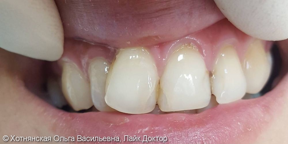 Эстетическая реставрация 4-х центральных зубов, материал Enamel Plus - фото №1