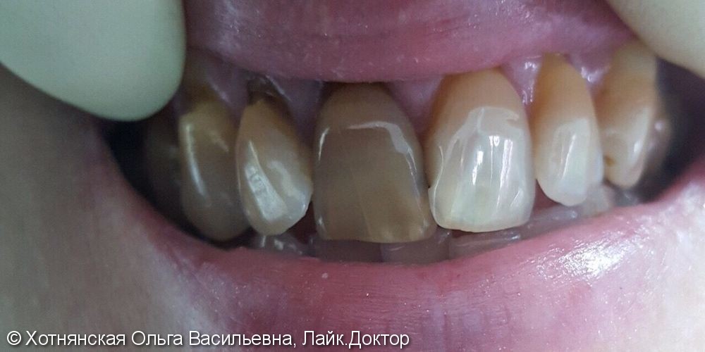 Реставрация 6-ти зубов проводилась за 3 посещения - фото №1