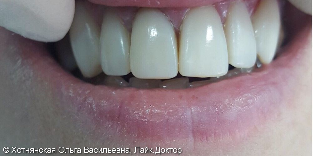 Реставрация 6-ти зубов проводилась за 3 посещения - фото №2