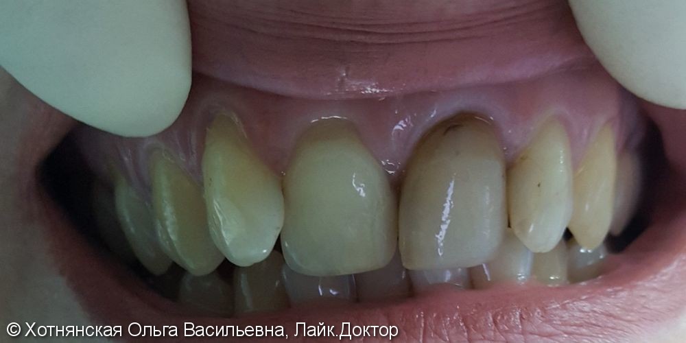 Эстетическая реставрация 4-х центральных зубов, до и после - фото №1