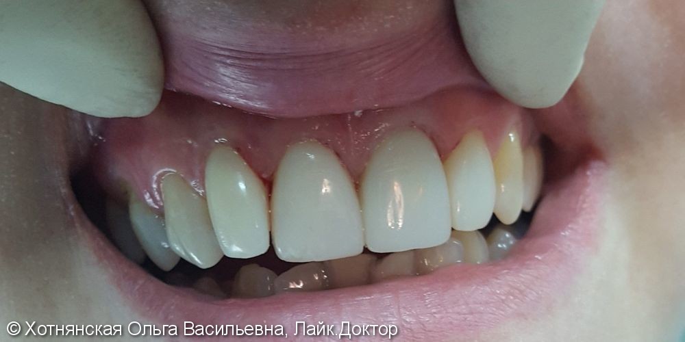 Эстетическая реставрация 4-х центральных зубов, до и после - фото №2