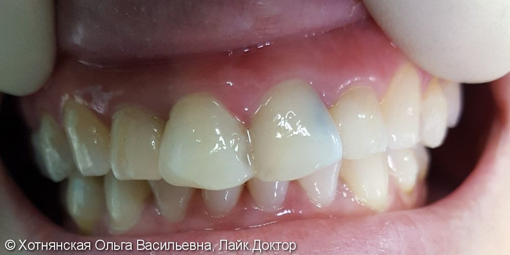 Результат эстетической реставрации 4-х центральных зубов - фото №1
