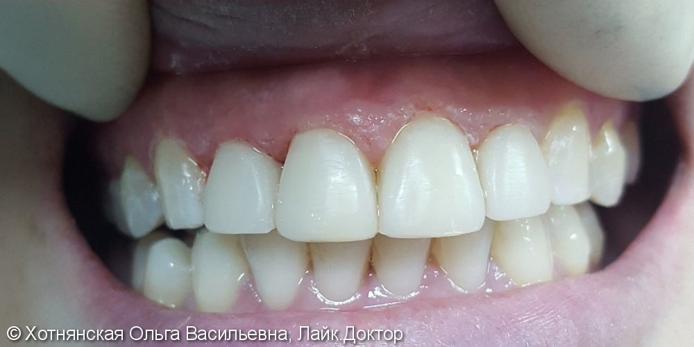 Результат эстетической реставрации 4-х центральных зубов - фото №2