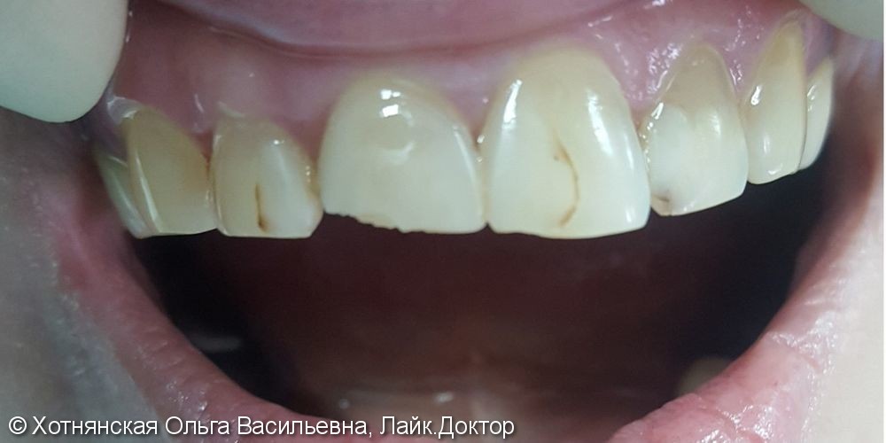 Эстетическая реставрация фронтальных зубов, до и после - фото №1