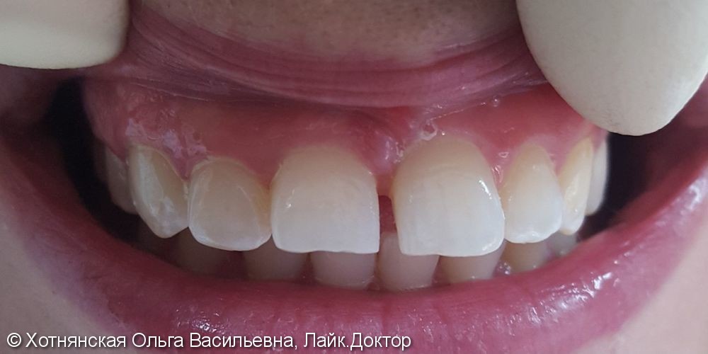 Быстро и недорого исправить проблему с центральными зубами - фото №1