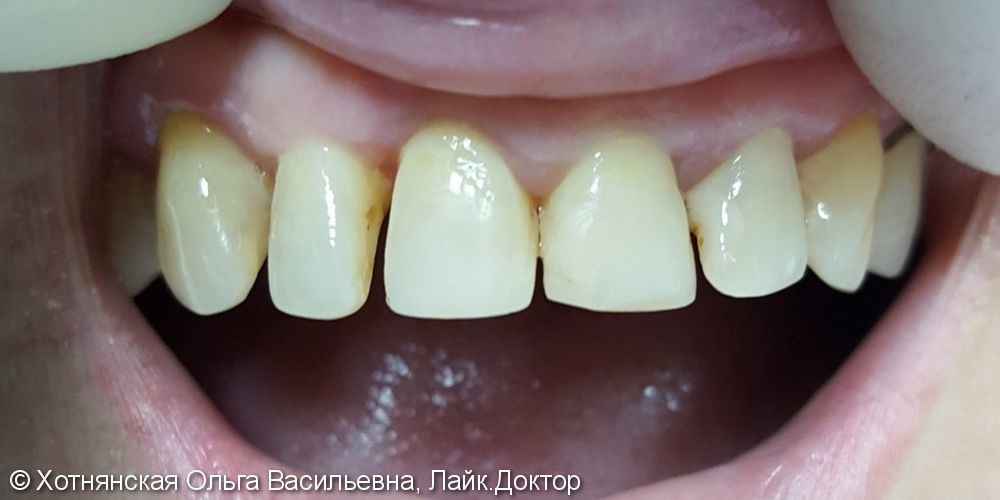 Эстетическая реставрация центральных зубов очень быстро и недорого - фото №1