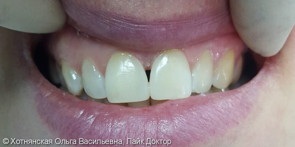 Реставрация 2-х зубов за ОДНО посещение - фото №2