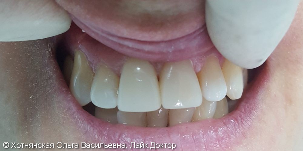 Эстетическая реставрация центральных зубов очень быстро и недорого - фото №2