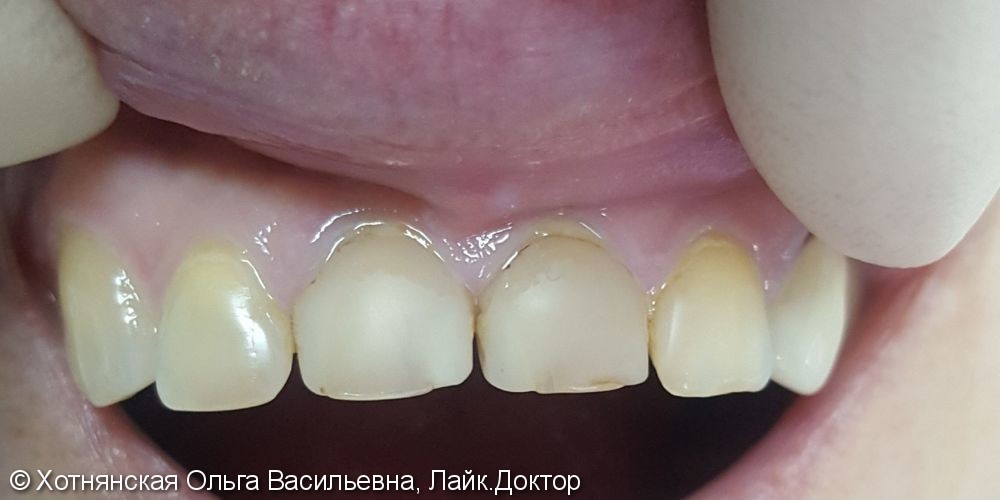 Реставрация 2-х центральных зубов - фото №1