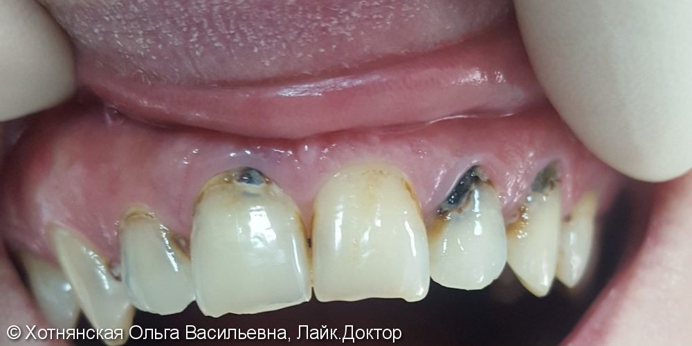 Реставрация 6-ти зубов, фото до и после - фото №1
