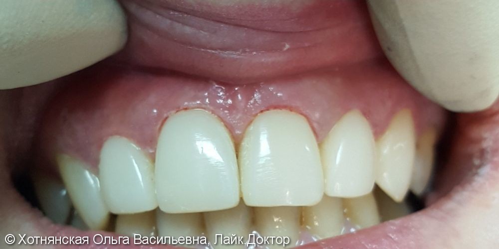 Реставрация 6-ти зубов, фото до и после - фото №2