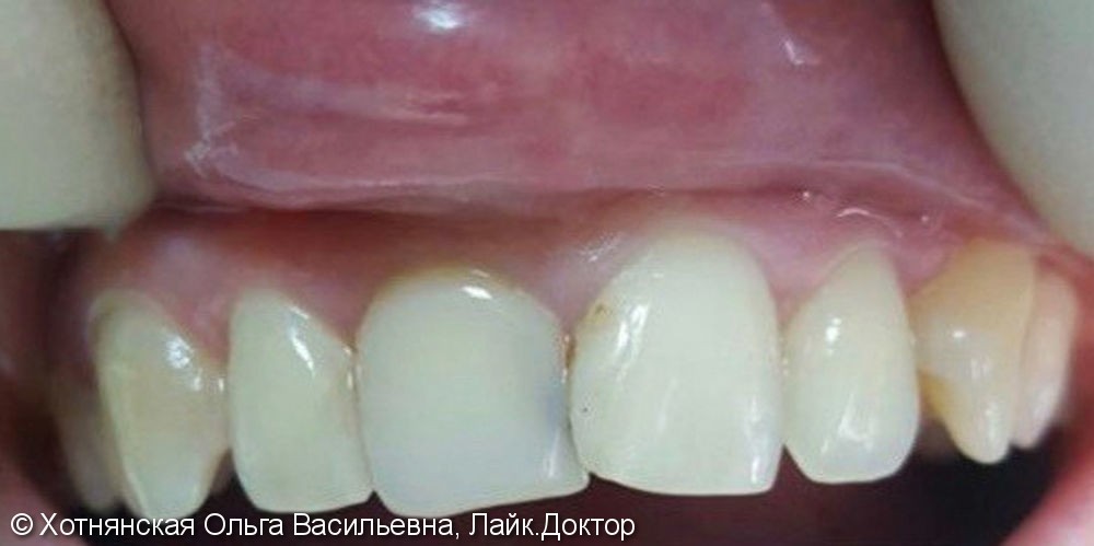 Эстетическая реставрация 2-х центральных зубов за 2 часа - фото №1