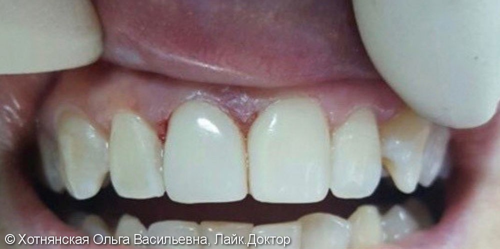 Эстетическая реставрация 2-х центральных зубов за 2 часа - фото №2